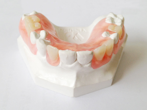 ノンクラスプデンチャー